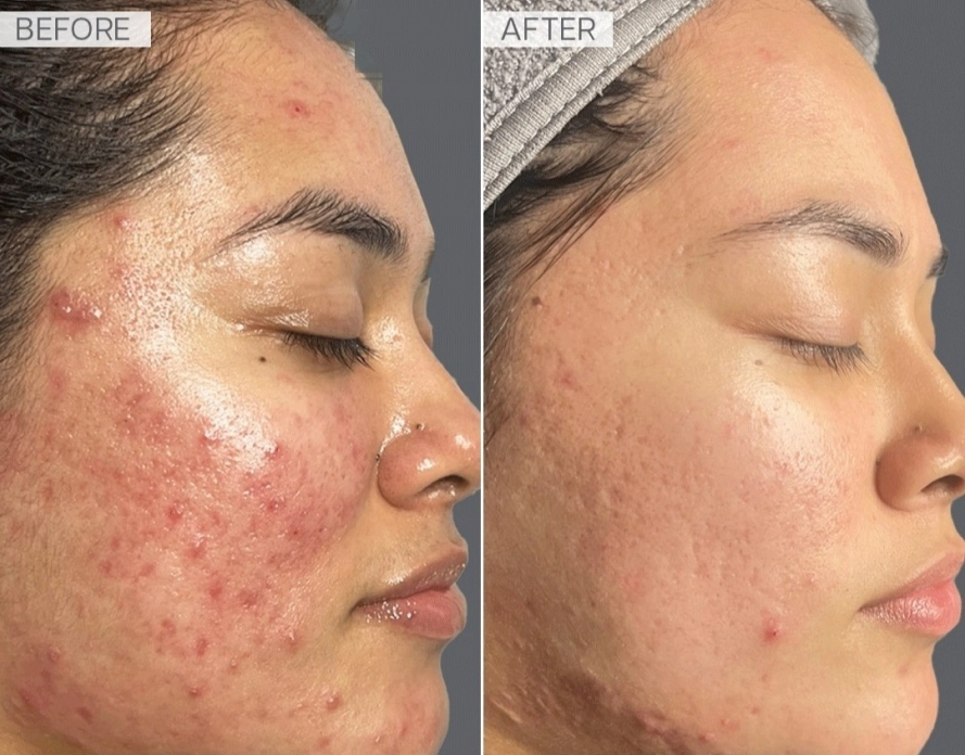 Acne Services