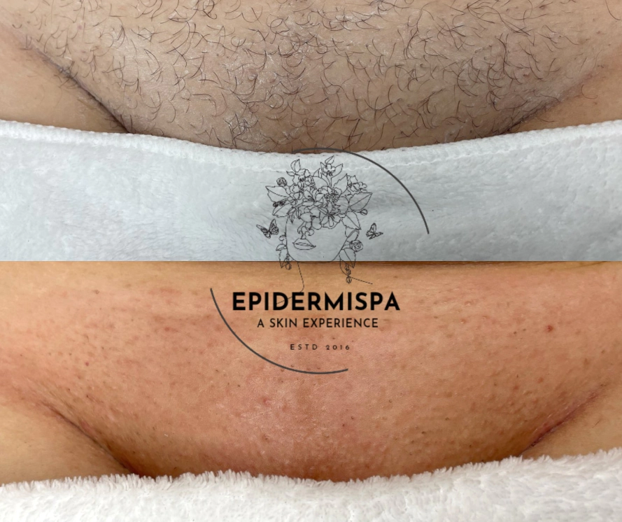 Hair Removal Sugaring Services